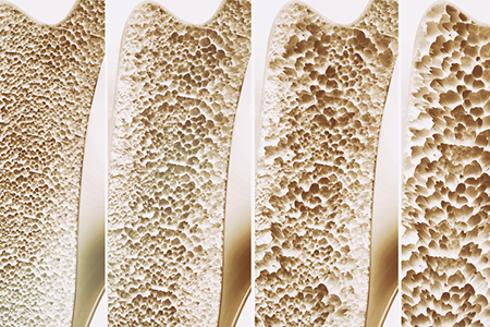 Osteoporose, Bindegewebeschwäche, Haarausfall, Gelenk- sowie Wirbelsäulenbeschwerden und wie Ayurveda hilft